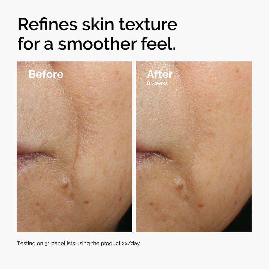 Before and after comparison of skin texture. After 8 weeks of twice-daily use of Caffeine 3% + Escin 1% Face Serum, the skin surface appears visibly smoother and more refined.