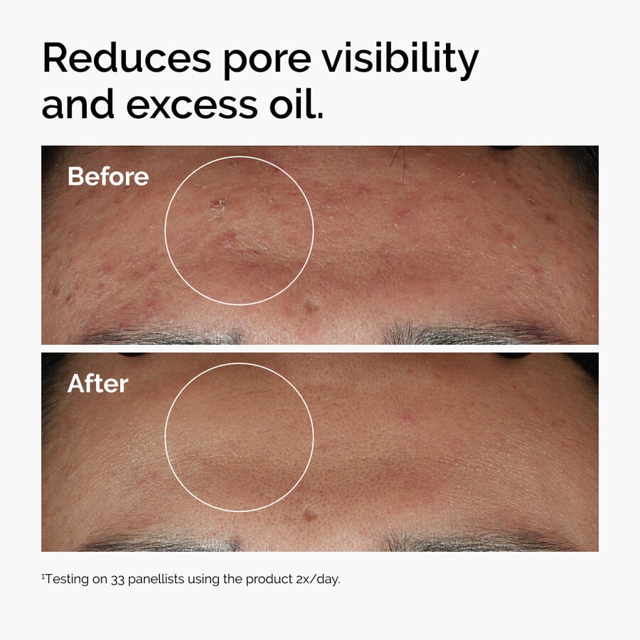 Before and after using Niacinamide 10% + Zinc 1%  to reduce oil and minimize pores.