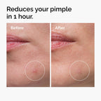 Before and After of Sulfur 10% Powder-to-Cream Concentrate reducing a pimple in 1 hour